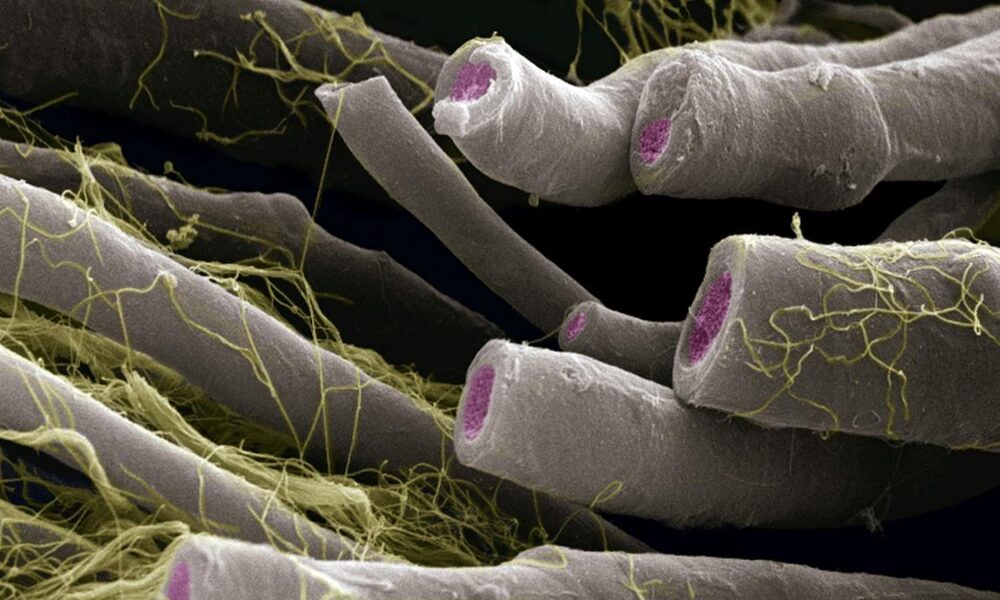 Out-of-balance bacteria is linked to multiple sclerosis, can predict severity: new research