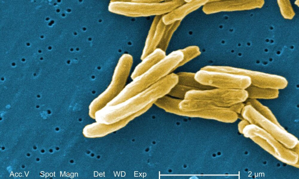 Indigenous TB test can enhance accuracy, speed up testing