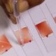 RRI scientists develop affordable device for preliminary screening of sickle cell disease