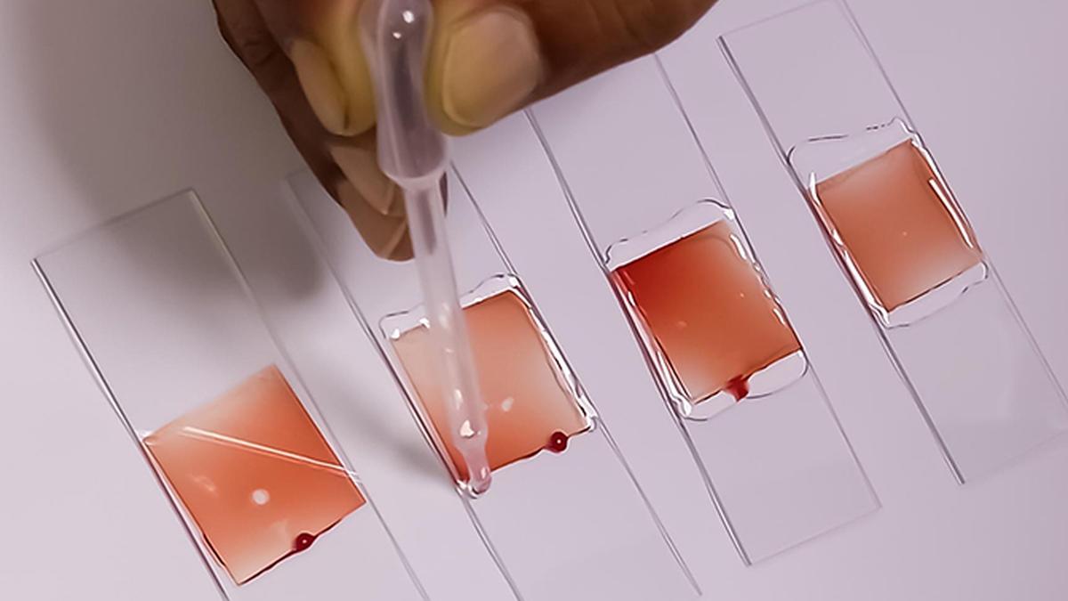 RRI scientists develop affordable device for preliminary screening of sickle cell disease