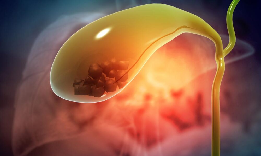 Toxic gallstones fuel gallbladder cancer crisis in Assam, says study