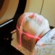 In a first, arc therapy beats tricky cancer while sparing nearby tissue