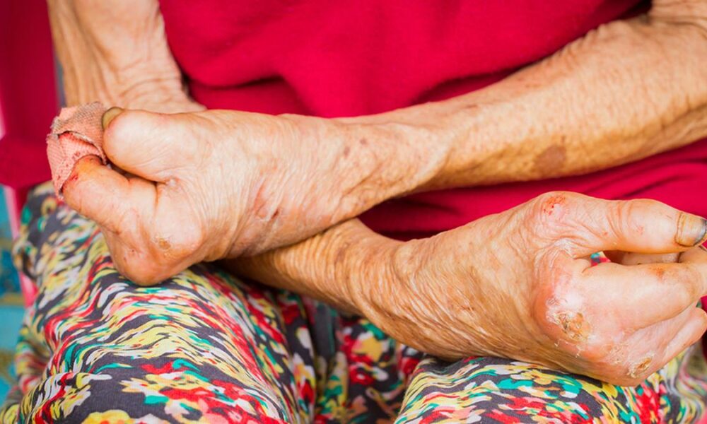 The link between leprosy and climate-change that we did not know about: an Indian story