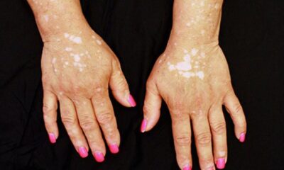 Towards empowerment: busting myths around vitiligo