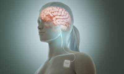 Deep-brain stimulation: nudging neurons