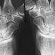 Early immune changes hint at ways to prevent rheumatoid arthritis