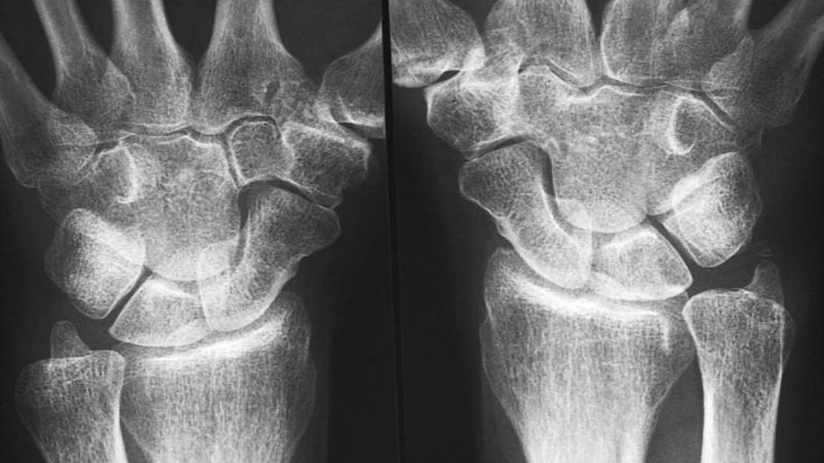 Early immune changes hint at ways to prevent rheumatoid arthritis