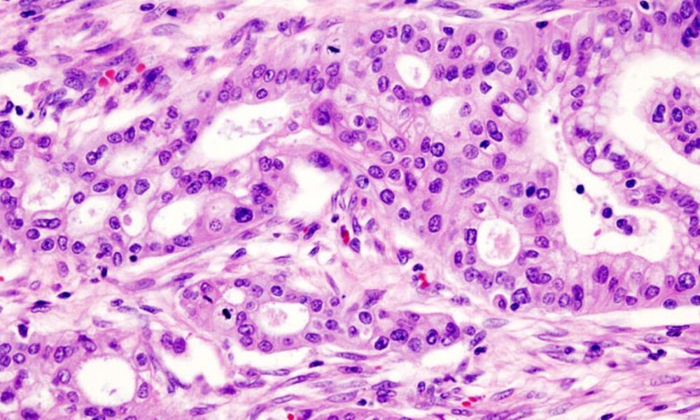 Hypoxia rewires membrane lipids, drives pancreatic cells to move: IIT-Bombay study