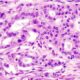 Hypoxia rewires membrane lipids, drives pancreatic cells to move: IIT-Bombay study