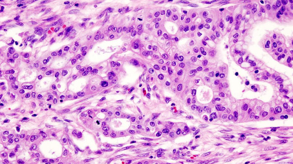 Hypoxia rewires membrane lipids, drives pancreatic cells to move: IIT-Bombay study