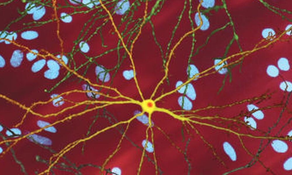 Researchers, families confront Huntington’s with rhythm and resolve