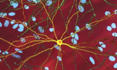 Researchers, families confront Huntington’s with rhythm and resolve