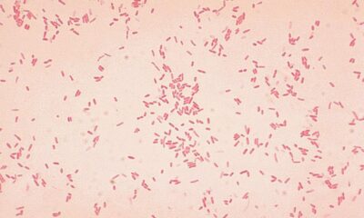 Microbe might spark first stages of ulcerative colitis: new study