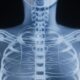 Large genetic study finds overlaps between schizophrenia, bone health