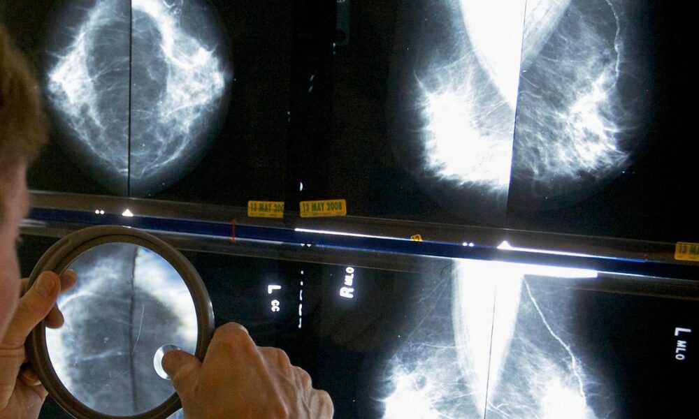 Breast cancer cases in India have more than doubled in three decades, experts say