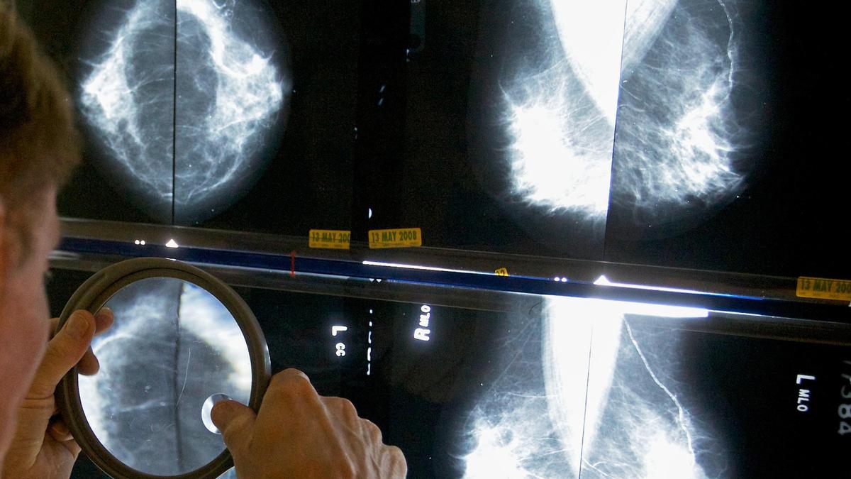 Breast cancer cases in India have more than doubled in three decades, experts say