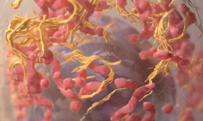 Cholesterol makes cells’ nuclei squishy, helping melanoma spread