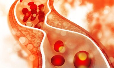 Life-saving numbers: what the 2026 U.S. cholesterol guidelines mean for everyone