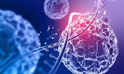 Can CAR-T, a therapy for cancer, help treat autoimmune diseases? | In Focus podcast