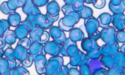 What the study of the mutant gene behind aggressive adult leukaemia can offer for treatment