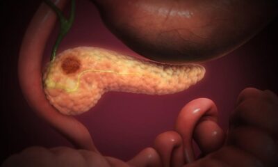 Hope for pancreatic cancer as new drug, daraxonrasib, shows promise