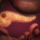 Hope for pancreatic cancer as new drug, daraxonrasib, shows promise