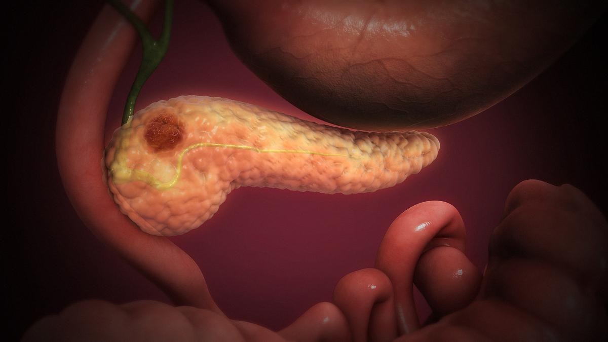 Hope for pancreatic cancer as new drug, daraxonrasib, shows promise