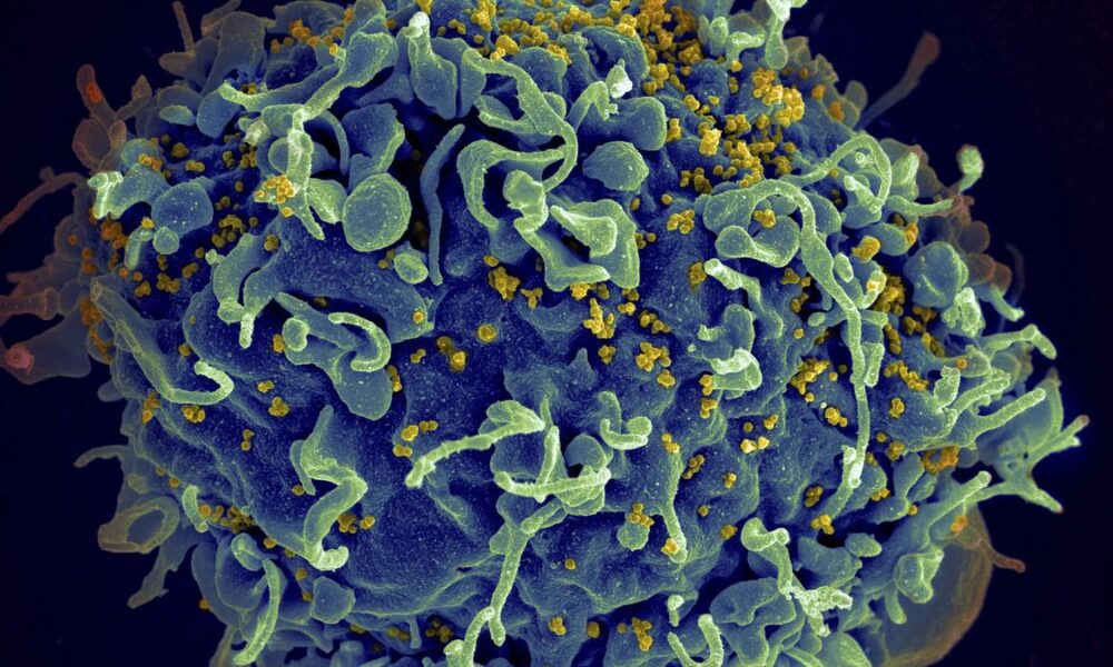 Small study hints that revving up immune cells might help fight HIV